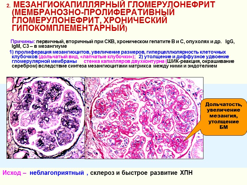 2.   МЕЗАНГИОКАПИЛЛЯРНЫЙ ГЛОМЕРУЛОНЕФРИТ (МЕМБРАНОЗНО-ПРОЛИФЕРАТИВНЫЙ ГЛОМЕРУЛОНЕФРИТ, ХРОНИЧЕСКИЙ ГИПОКОМПЛЕМЕНТАРНЫЙ)     
